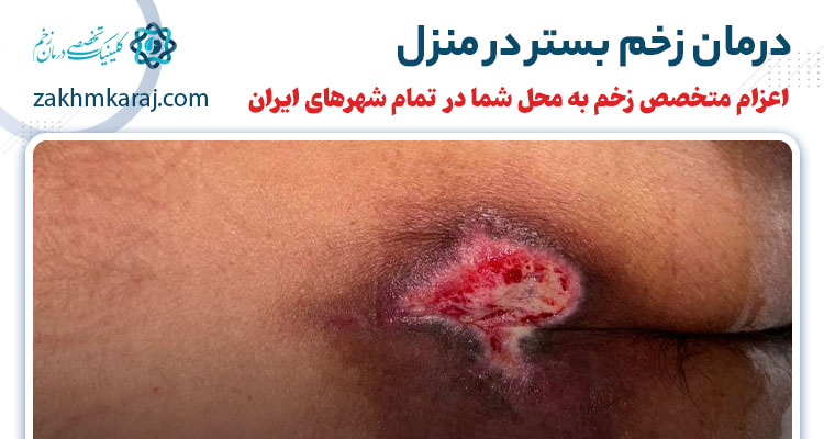 درمان زخم بستر در منزل