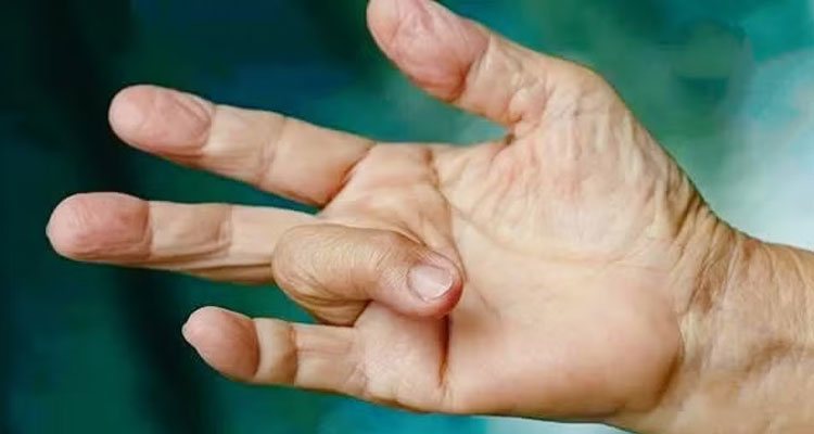 دیابت و عارضه تریگرفینگر