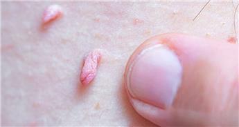 آیا کودکان نیز به ویروس HPV مبتلا می شوند؟