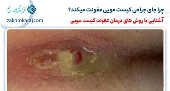 چرا جراحی کیست مویی عفونت میکند؟ روش های درمان آن چیست؟