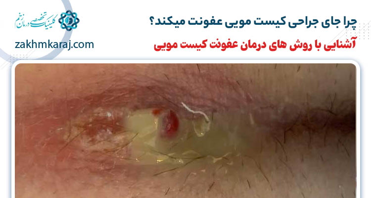 عفونت جای زخم جراحی کیست مویی و درمان آن