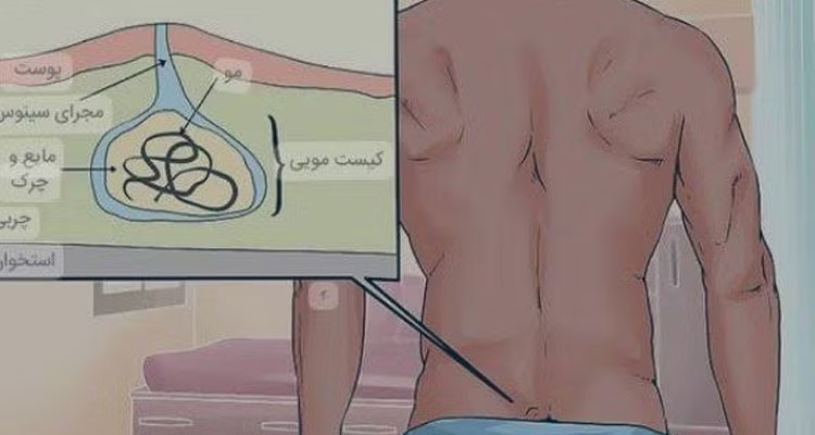 سینوس پیلونیدال