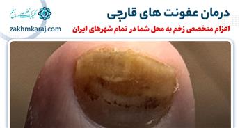 عفونت های قارچی پوستی چیست و چگونه درمان می شود؟