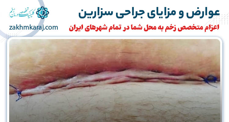 مزایا و عوارض سزارین چیست؟