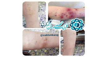 ایجاد عفونت و سلولیت در زخم با استفاده از درمان‌های خانگی