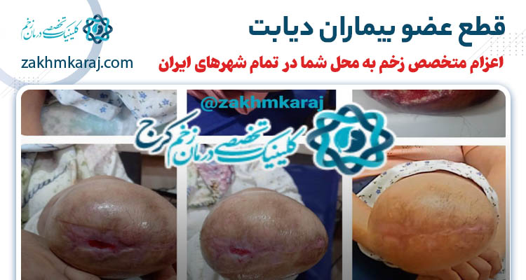 قطع عضو بیماران دیابتی