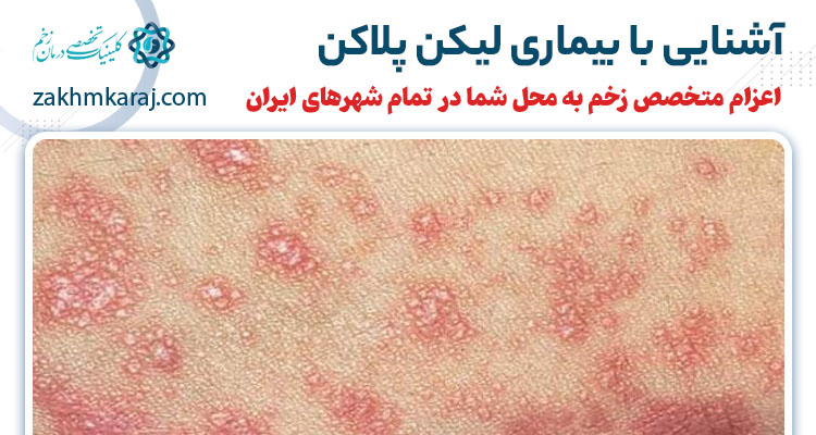 بیماری لیکن پلاکن چیست؟