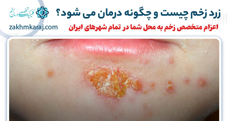 زرد زخم چیست و چه علائمی دارد؟