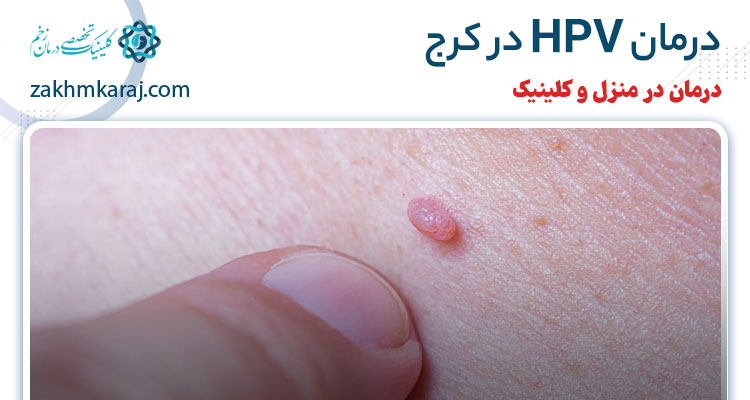 درمان زگیل تناسلی در کرج