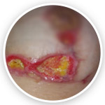 درمان عفونت ماموپلاستی