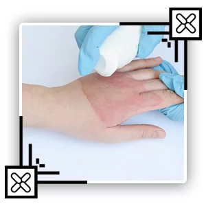 پانسمان سوختگی در منزل