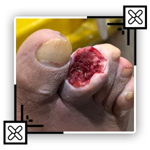 درمان زخم عفونی