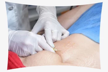 پلاسما تراپی