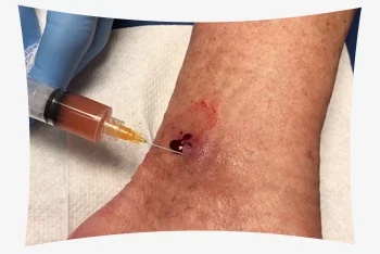 پی آر پی زخم