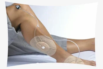 وکیوم تراپی