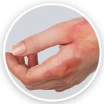 درمان سوختگی