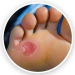 درمان زخم دیابتی