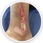 درمان عفونت پلاتین پا