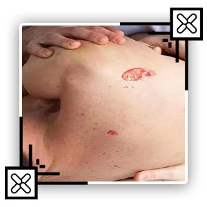 درمان زخم بستر در منزل