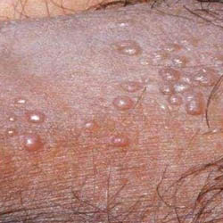 درمان زگیل تناسلی در کرج