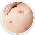 درمان زخم بستر